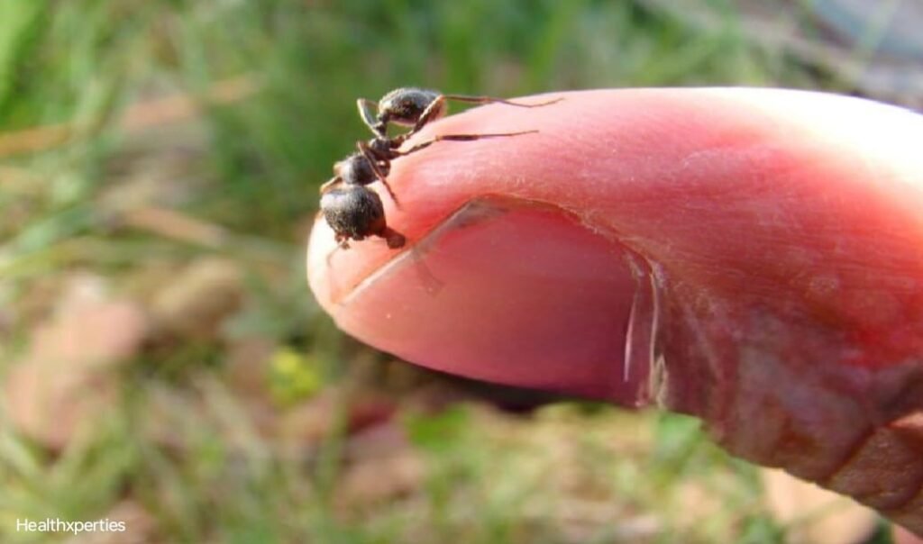 carpenter ant bite